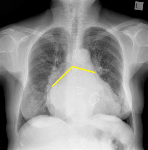 lv enlargement radiopaedia|elevated left ventricular volume x ray.